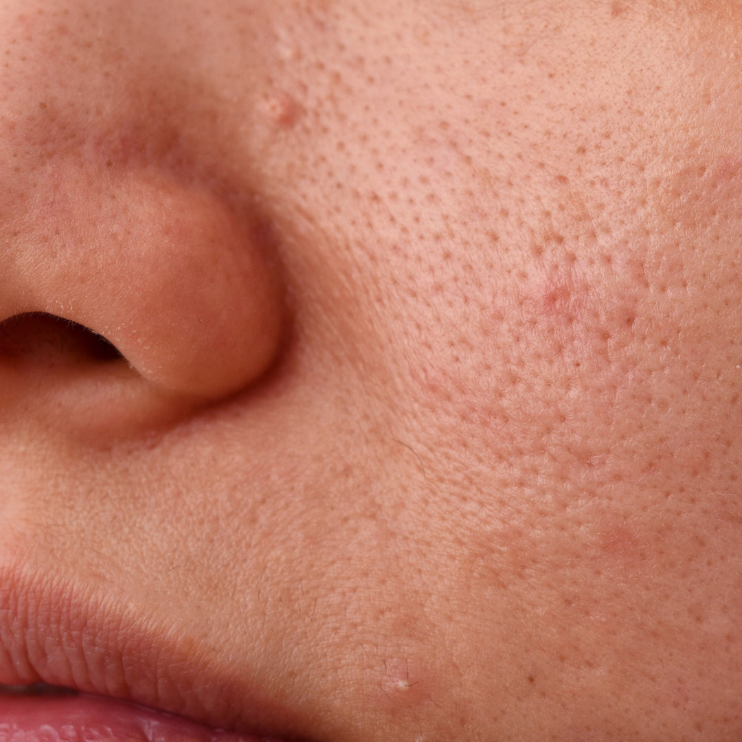 Clay mask to treat blackheads.